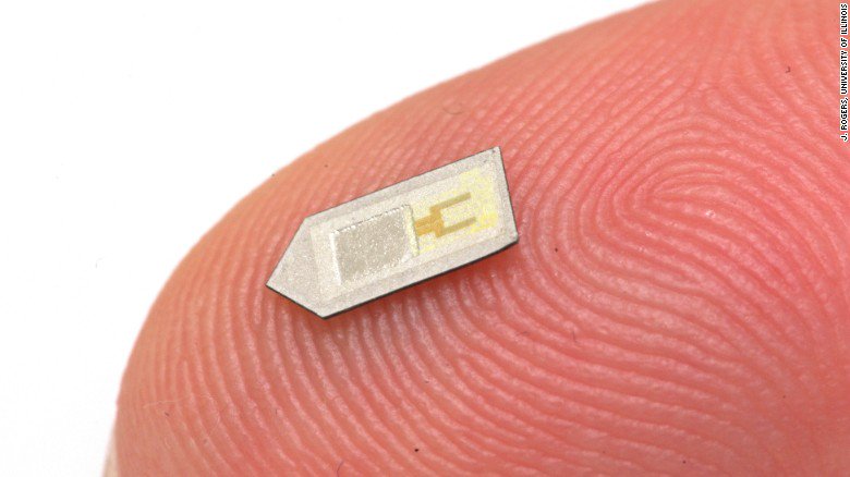 CNN's tweet image. Researchers working on tiny implant that monitors traumatic brain injury, then melts away cnn.it/1QasRuM