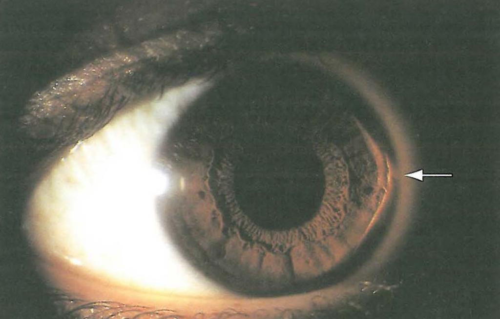 Eye_Atlas's tweet photo. #Rizzutti sign, in #keratoconus, conical reflection on nasal cornea when a penlight is shone from the temporal side. https://t.co/nsQgBECyuh