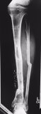 Nick Hancock &amp; Southampton Limb Recon Unit grow 120mm of new tibia. Patient well and working. <a href="/SotonKneeClinic/">Southampton Knee Clinic</a>