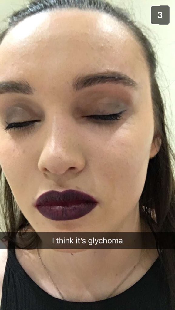 When <a href="/sara_knott/">Sara Knott</a> gets jaeger in her eye