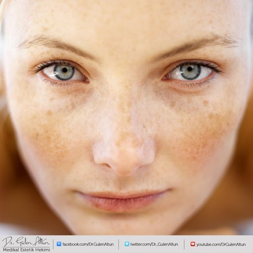 Ben tedavileri hakkında daha fazla bilgi almak için;
 0212- 669-82-59 
#iletişim #leke #ben #tedavi #sağlık #lazer