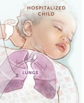 Review Article: Viral Bronchiolitis in Children. nej.md/1TC0TsK