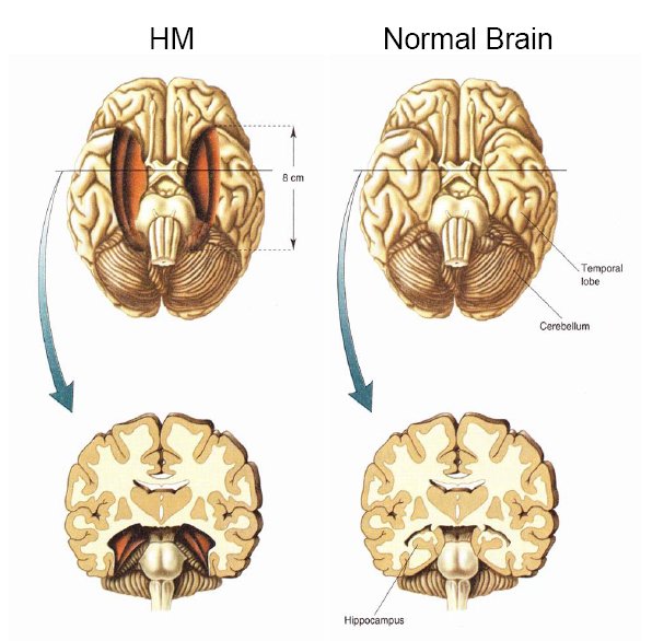 Realscientists Looking For Volunteers H M Developed Epilepsy And Didn T Respond To Standard Treatments Had Part Of His Brain Removed To Stop Seizures T Co Dncqf0pdr5 Twitter