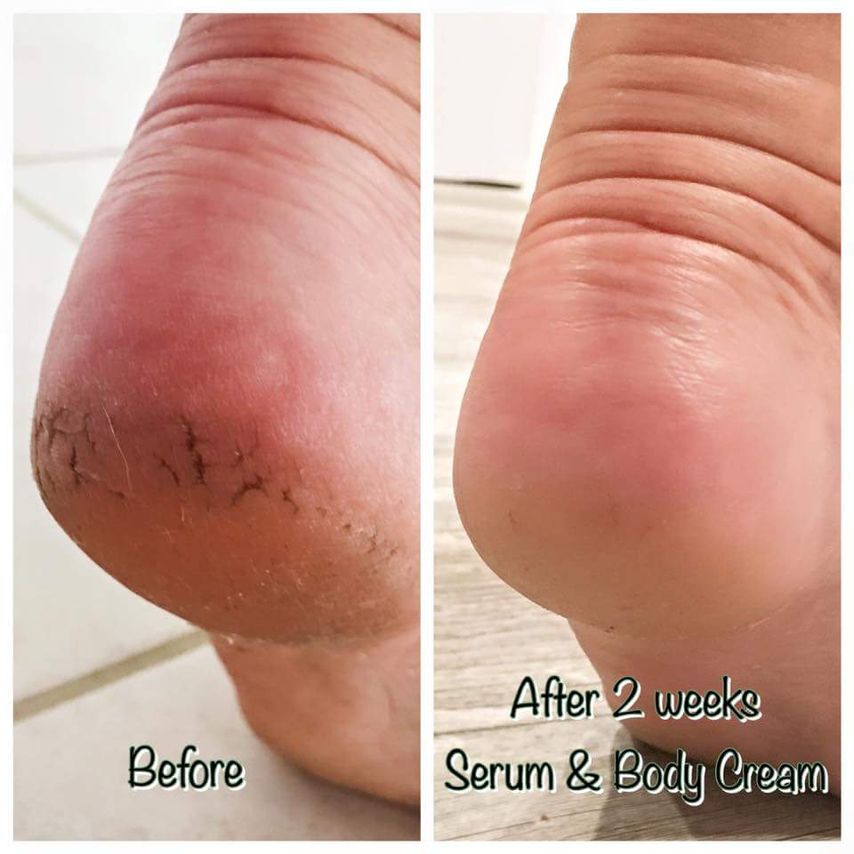 GrandLips's tweet photo. Ask how!! #amazing #janpromo #specialgiftset #skincarethatworks #adultderivedstemcell #australia #newzealand https://t.co/8ptxzBbpaN