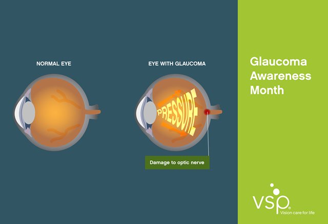 VSPVisionCare's tweet image. Glaucoma is the #1 cause of blindness in the U.S. See who's at risk: shout.lt/bqdC7 #GlaucomaAwarenessMonth