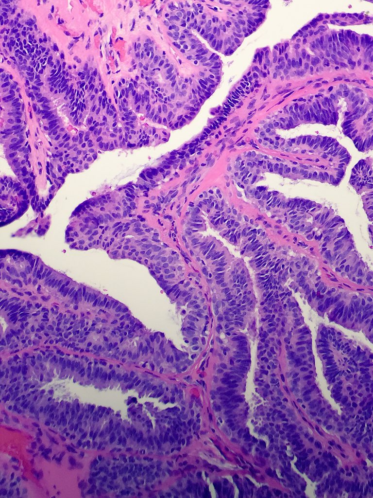 Hidradenoma papilliferum: Not difficult or uncommon, but tricked me as PGY2 in unknown conf in front of everyone!