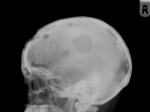 dmiguelmolina's tweet photo. Afección a huesos del cráneo en un caso de "Mieloma Múltiple", una neoplasia de células plasmáticas. https://t.co/T9QxN6II2u