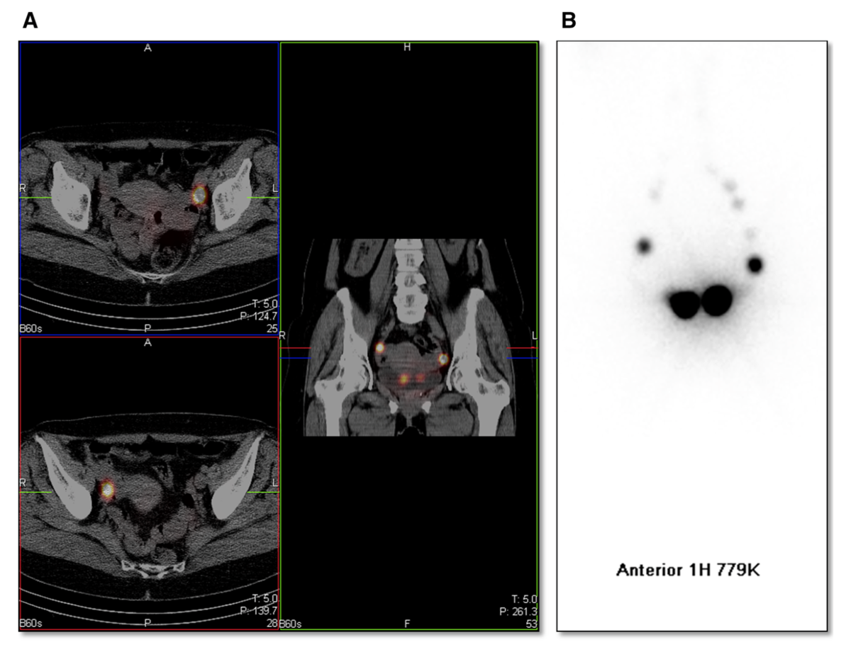 FEB ISSUE: Added Value of SPECT/CT in #SentinelLymphNodes Mapping for #EndometrialCarcinoma. ow.ly/XrnIM
