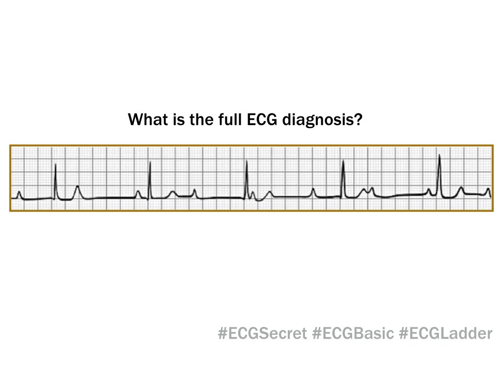 ECGTalk's tweet photo. Practice to draw ladder diagram & get the full ECG dx! Good nite folks...
#ECGBasic #ECGSecret #ECGLadder https://t.co/SvYssyqP9T