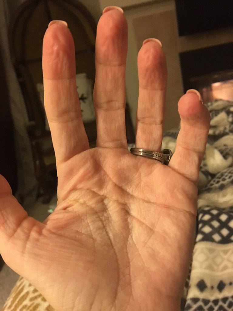 ChannonRose's tweet image. My hands after a short while of being wet. Have had this for over a year now. No dr’s know what causes it. 😔