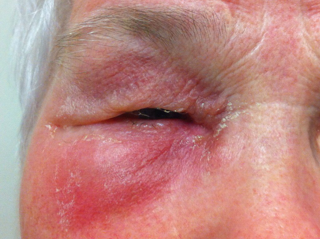 Douleur ++ en lat du nez et pus au canthus inférieur. Pas de chgmt vision ou dlr mvt occulaires.  DX?