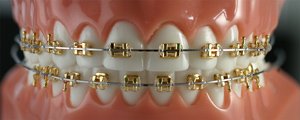 In the 1900s orthodontists used gold, platinum, silver, steel (and occasionally wood!) to form braces and bands!