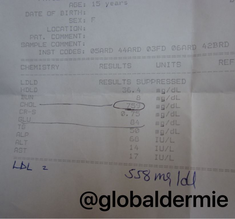 globaldermie's tweet photo. 15yo Ethiopia Chol759LDL558 tendinous #xanthomas familial #hypercholesterolemia #dermatology #pediatrics #globalderm https://t.co/6sHOEM19Z0