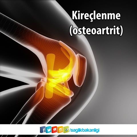 Kireçlenme;eklem kıkırdağı, bunun yanı sıra bağları ve altındaki kemiği etkileyen hasarlayıcı bir eklem hastalığıdır