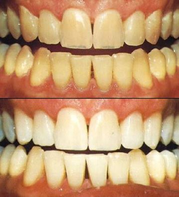 factsabt's tweet photo. #DontYouKnow
The Romans used to clean and whiten their teeth with urine. Apparently it works Plz don’t do it, though https://t.co/9HPHJl90dj