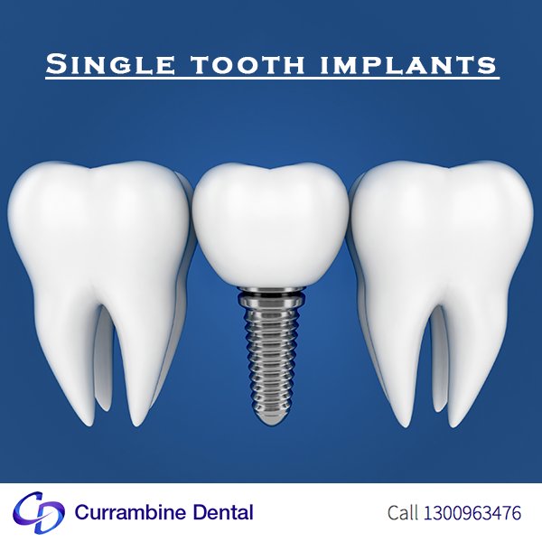 CURRAMDental's tweet photo. A single tooth implant ensures that the teeth on either side are not affected.
https://t.co/gCxRmzGlbu https://t.co/5Hcjpxnb5z