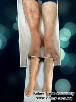 phoebe871124's tweet photo. Effective Herbal Medicine For Leg #Swelling Due To #HighCreatinine
https://t.co/iM0XEpvmeX https://t.co/CkAPOQvgwt