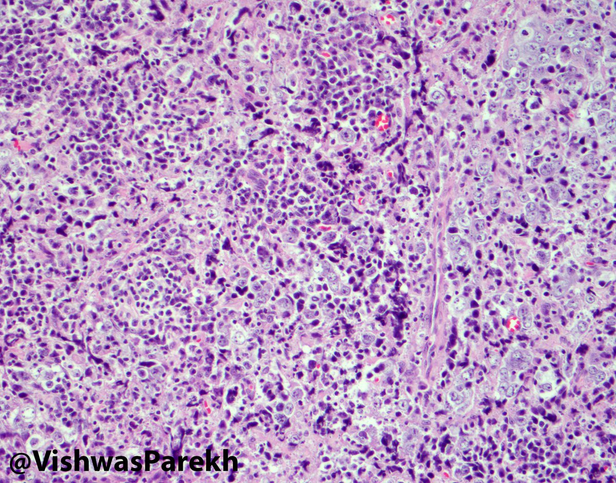 VishwasParekh's tweet photo. #Oropharyngeal #SquamousCellCarcinoma: Different flavor #CK+ #p16+ #HPV- #EBV- #Tonsillar #Carcinoma #ENTPathology https://t.co/6YBf2J3V36