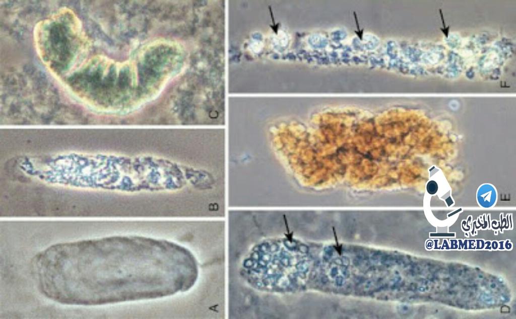 LabMed2016's tweet image. Urinary casts (phase contrast microscopy).