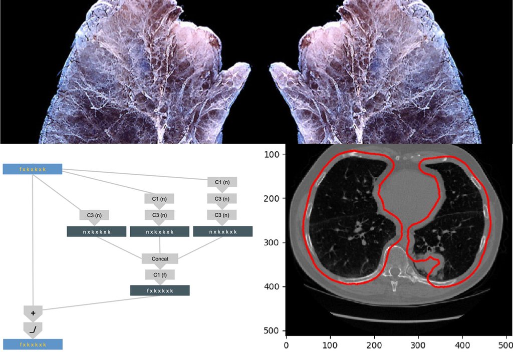 Team Deep Breath approached lung cancer detection using a combo of segmentation, xfer learning &amp; u-nets #DataSciBowl blog.kaggle.com/2017/05/16/dat…