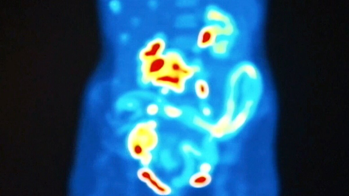 CTVNews's tweet photo. Low investment, high mortality: The case for spending more on ovarian cancer https://t.co/AqtKrX0WeV https://t.co/Cl02pirl2k