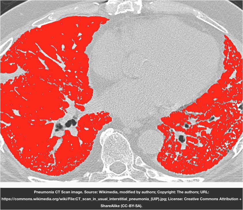 jmirpub's tweet image. Enhancing #ComparativeEffectiveness Research With Automated #PediatricPneumonia Detection in a Clinical Repository jmir.org/2017/5/e162/