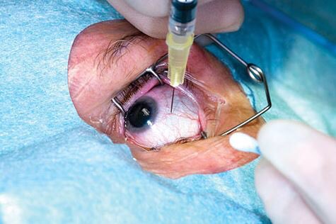 Harry22myBoo's tweet image. Imma bout to gross people out. This is what's happening to me in a few moments! I can't even put Visine in my 👀😩 #eyeinjection #myeyesmyeyes