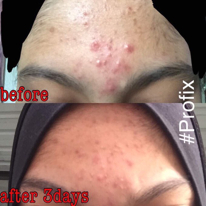 ProfixJohor's tweet image. 📣📣SIAPA NAK JADI GENG MUKA CANTIK MASA RAYA? ANGKAT TANGAN!! 📣📣📣

Berminat? Sila whatsapp 0127479928

#profix #profixjb #profixpasirgudang