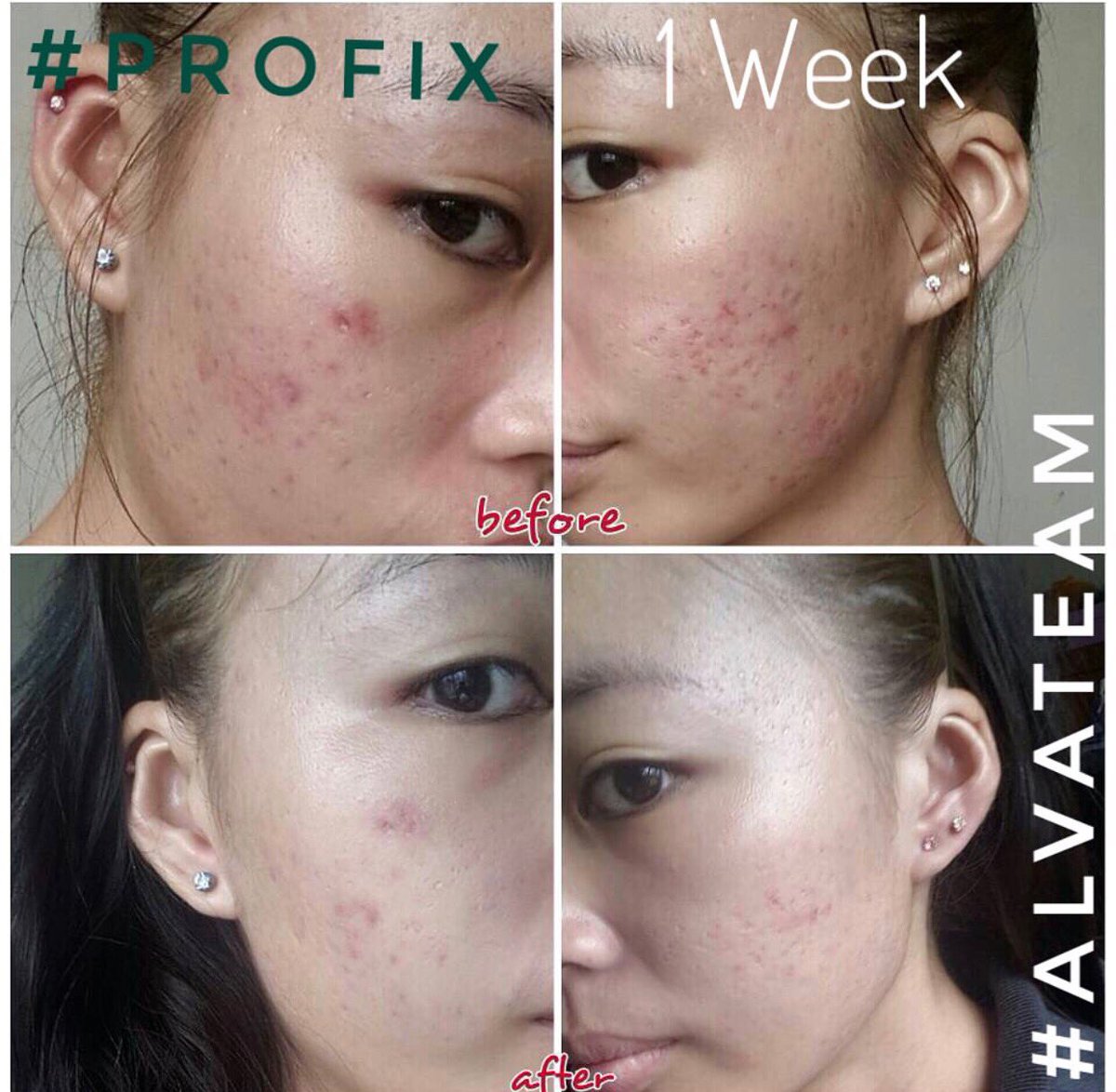 ProfixJohor's tweet image. Rasa down bila muka jerawat batu? Nak pergi rawatan laser tapi kurang modal? wasap.my/60127479928