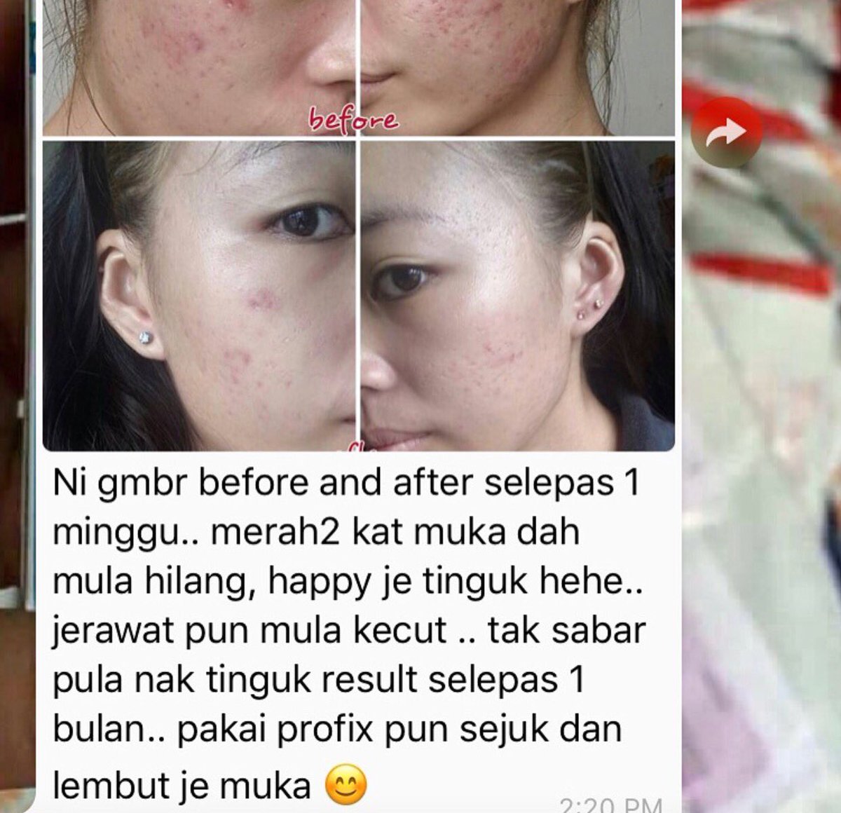 ProfixJohor's tweet image. Rasa down bila muka jerawat batu? Nak pergi rawatan laser tapi kurang modal? wasap.my/60127479928