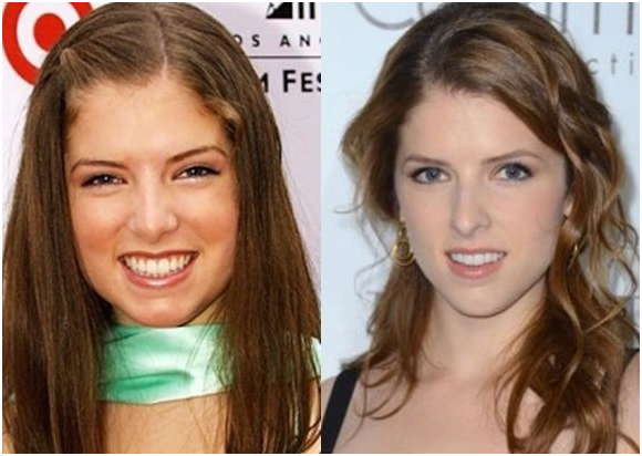 New post (Anna Kendrick Nose Job Before & After) has been published on ...