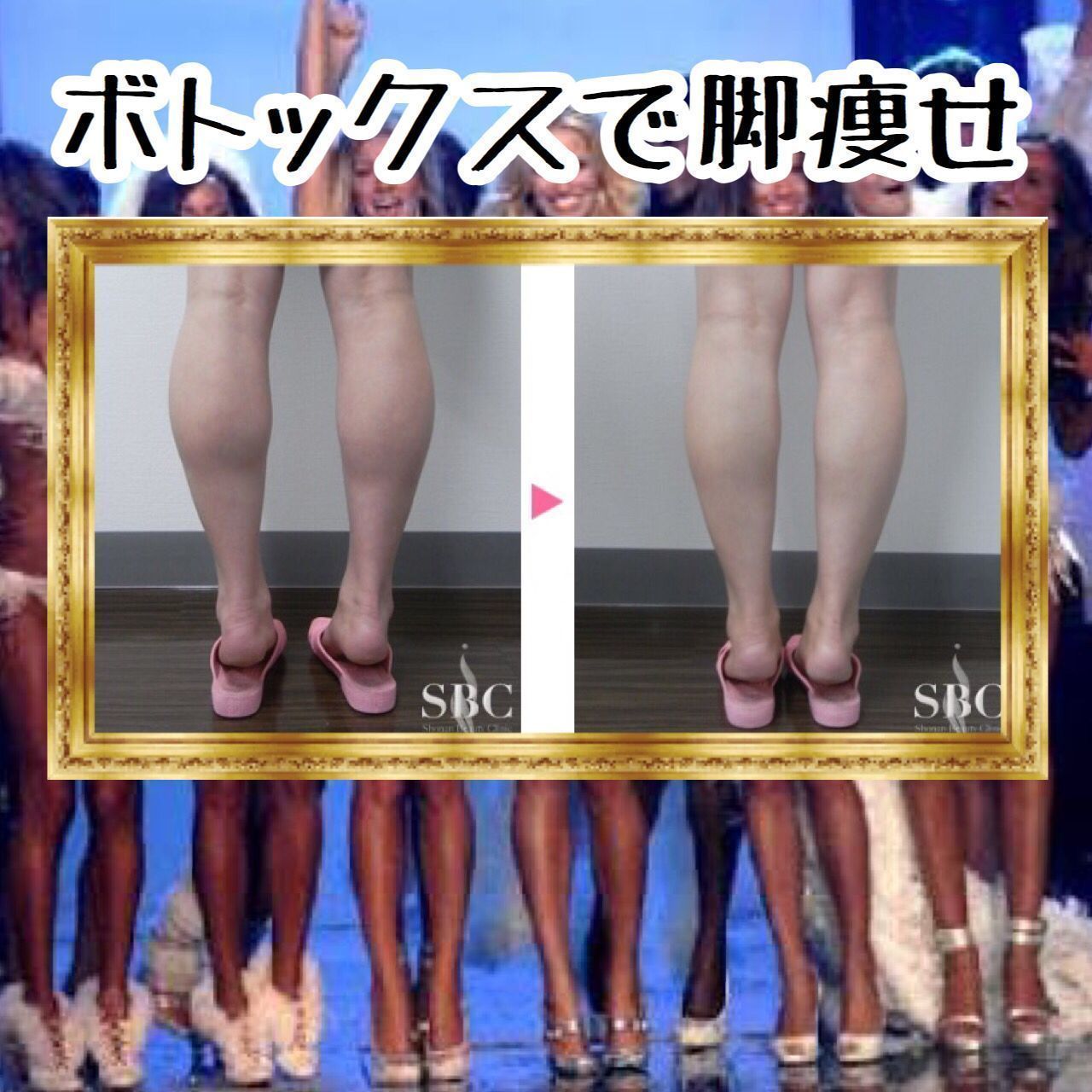 湘南美容クリニック 池袋東口院 足が太い 脂肪とは限りません ガッシリしたふくらはぎをすっきり細くしたい方はボトックス 筋肉の動きを抑制する事で鍛えられた男前な脚からしなやかな女性らしい脚にしてくれます ふくらはぎボトックス 61 560