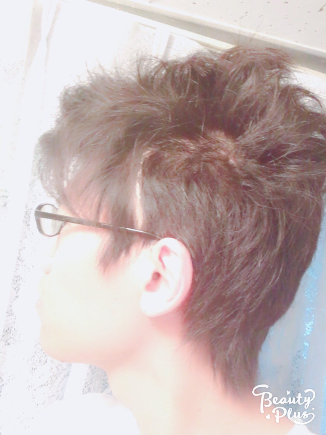 とぶとりアスカ これが俺が短髪にしたがらない理由 ハゲに間違われるし ハゲじゃなくて手術の跡です 髪型 事故 若ハゲ 十円ハゲ 寝癖すごい T Co Ojvkcz5nf4 Twitter