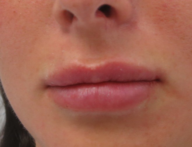 DrCharlson's tweet photo. Lips plumped and redefined with dermal filler is a popular cosmetic treatment for a perfect pout #dermalfiller #lips https://t.co/voTq8diPjS