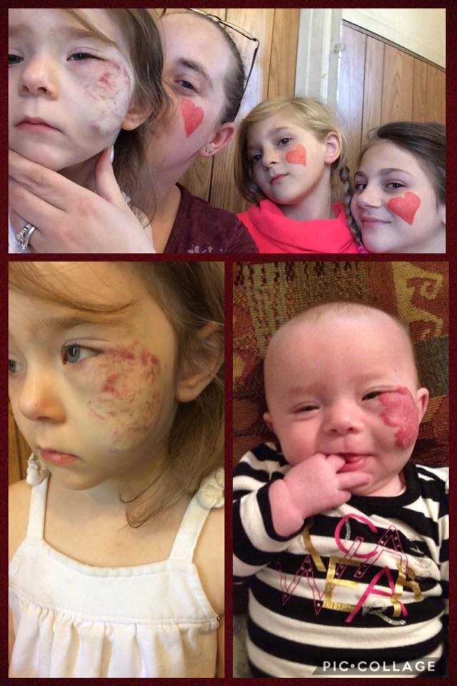 VBirthmarks's tweet photo. Thank you for all your support yesterday, Stef, #putonyourbirthmark has been such a great awareness campaign. #vbfawareness https://t.co/cKdcMPvN3z