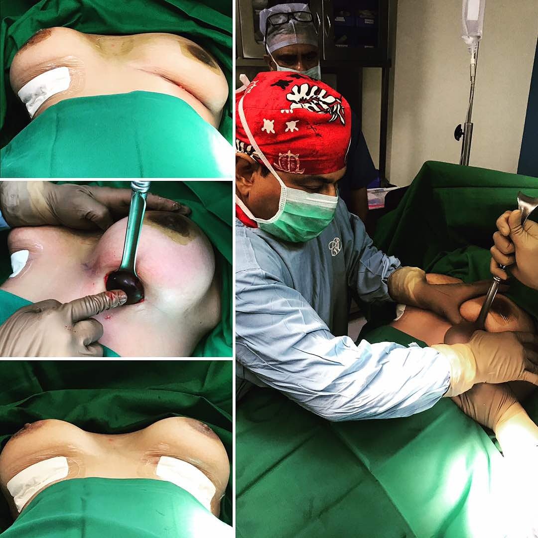 Empowered another young woman with droopy breasts. #breastimplants #breastsurgery #CosmeticSurgeryInstitute #COSMETICSURGERY