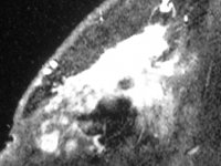 centralnebraska's tweet photo. The controversial preoperative #breastMRI have prove to be more accurate than #mammography and #ultrasound: https://t.co/Ib4JqcX58o https://t.co/TXXM2Fp1tf