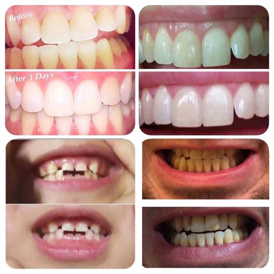 gwenaebly's tweet photo. Buy one get one for 1/2 price!
🚫 No Bleaches or Harsh Chemicals
✅ Gentle on Sensitive Teeth 
✅ Amazing 4 Wine, Coffee, &amp; Nicotine Stains https://t.co/iW3q5J24VF