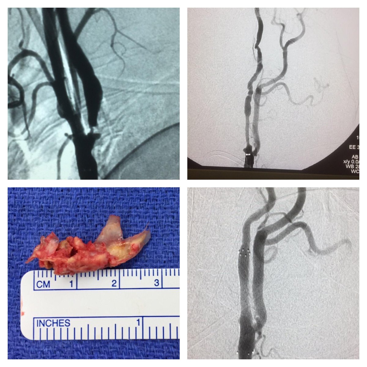 openaccessinfo's tweet image. carotid endarterectomy &amp;amp; carotid stenting can greatly diminish future risk of stroke. - Dr. Robert Starke