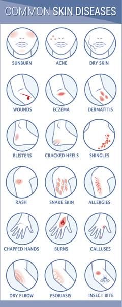 NaturalFindings's tweet photo. Repair common skin diseases #eczema #psoriasis #skincare #homeopathy #homeopathic #naturalremedy #dermaClear https://t.co/elmAgvT2Sr https://t.co/My5zDH997L