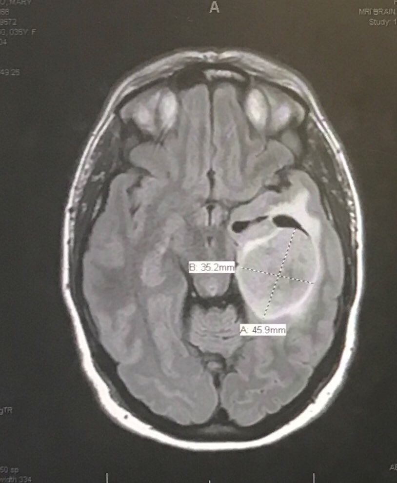 Lifeiskitsch's tweet image. Pre-surgery MRI photo of my Anaplastic Astrocytoma. I ran, did strength workout, &amp;amp; went to work on day tumor was discovered (seizure). #btsm