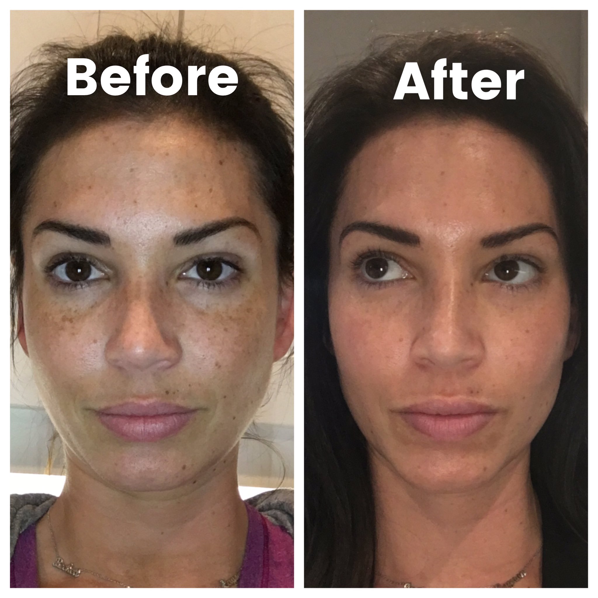 “BBL PhotoFacial and ProFrac Laser before and after - and it's onl...