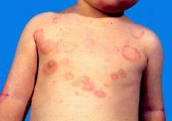 rheumaticfev17's tweet photo. Sorry dude, you should've done a better at taking your antibiotics. #sorry #notentirlymyfault https://t.co/66GNAkKrcj