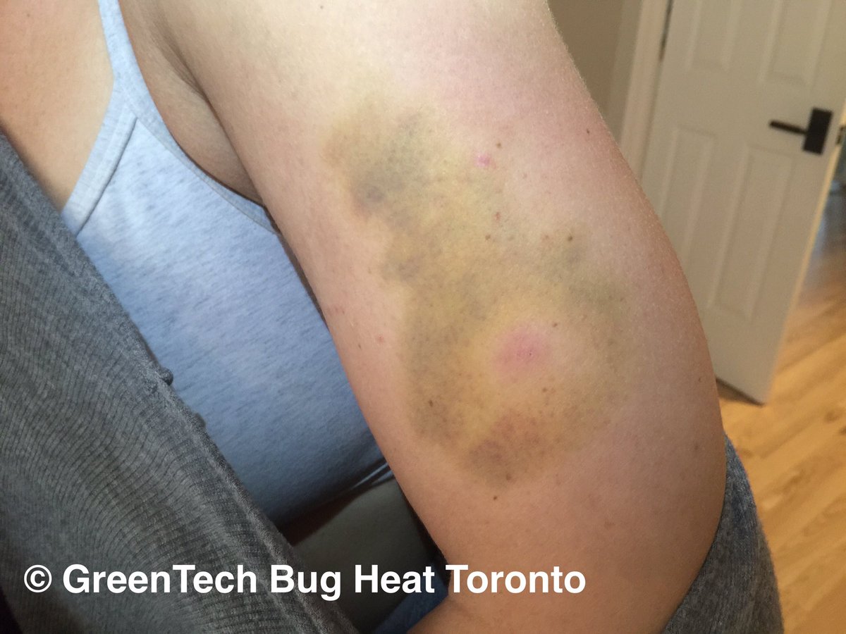 This is the first time we've ever seen this! A confirmed  #BedBug #Bite somehow caused this.

More here: greenbedbugheattreatment.ca/Bed-bug-welts.…