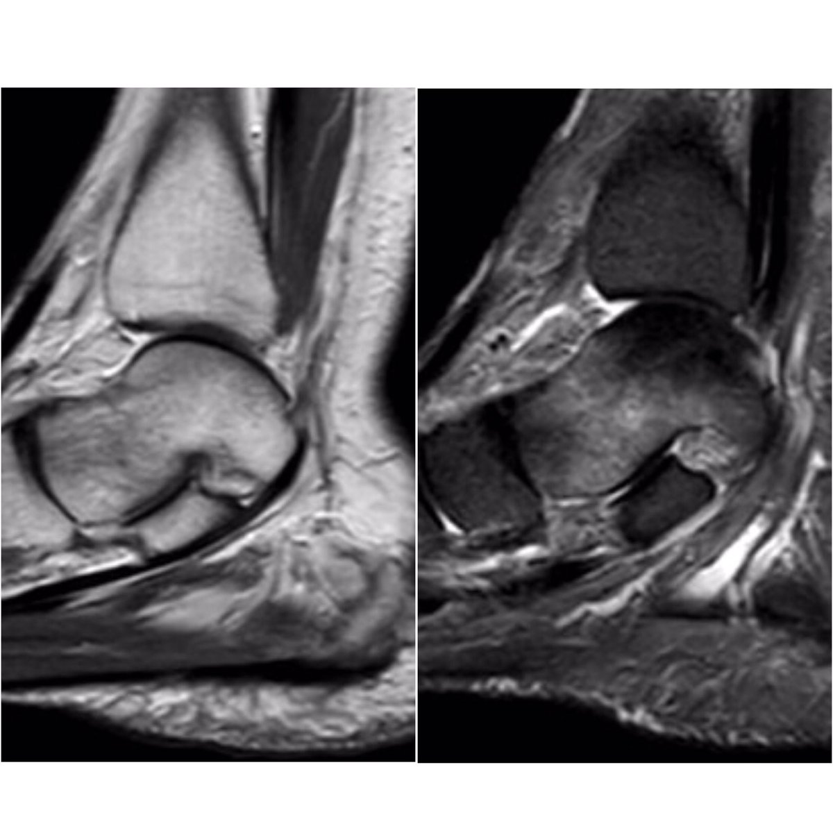 CursoMSKMexico's tweet photo. Femenina de 52 años con dolor en tobillo de 1 mes de evolución. Cuál es su diagnostico? #mskimaging #cursomskmexico #mskrad #learningmsk https://t.co/VbMKhVUzrR