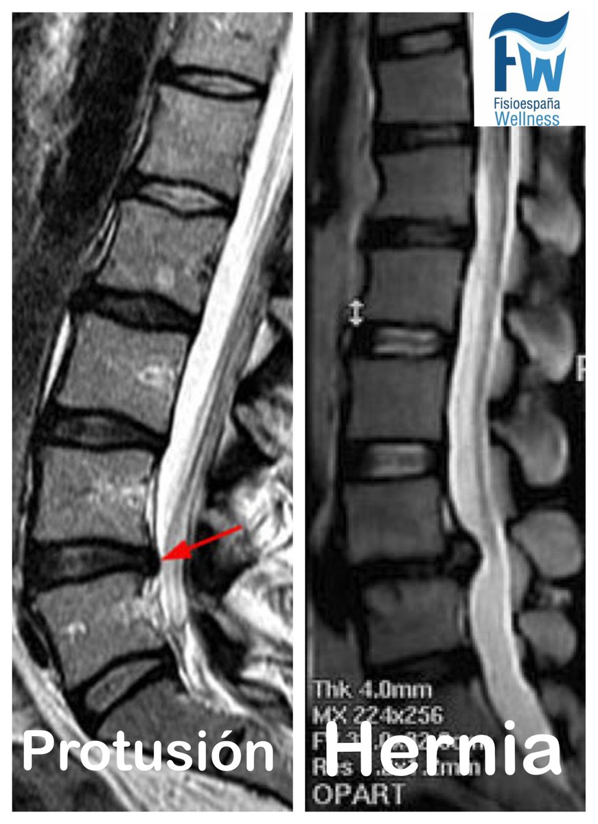 FisioeWellness's tweet photo. Hoy os dejamos esta imagen para diferenciar
entre #protusion y #hernia discal. En ambas la #fisioterapia es clave para disminuir el #dolor https://t.co/PF348J3ITX
