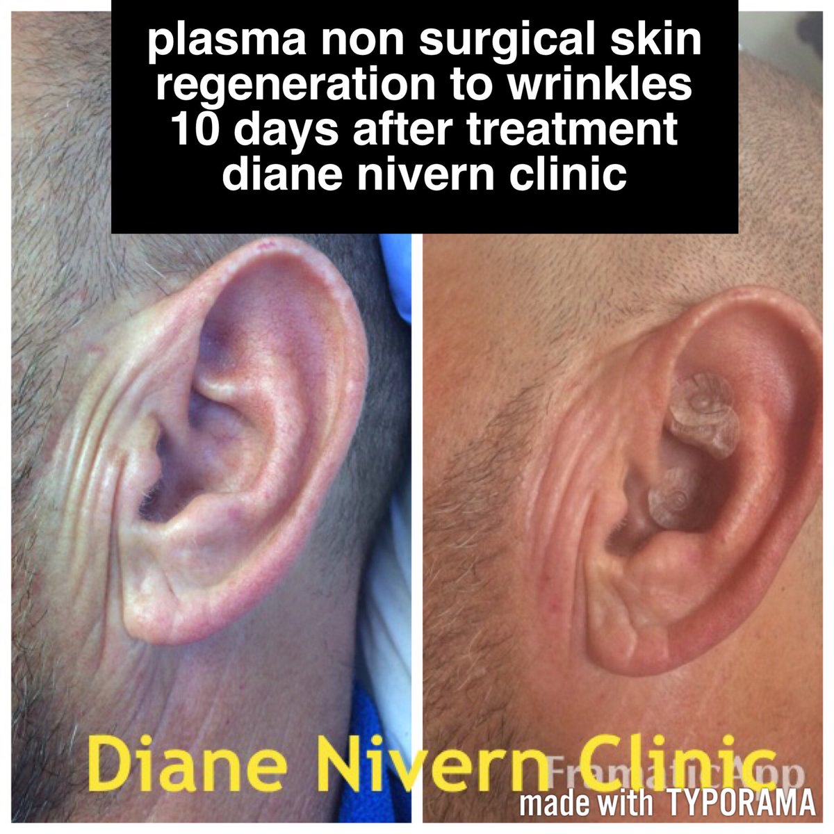 DianeNivern's tweet photo. Deep static wrinkles & loose skin tightened with #plasmasublimation #beamwave #plexr #skinclinic #Manchester #wrinkles #smootherskin https://t.co/7jN4Azqbrr