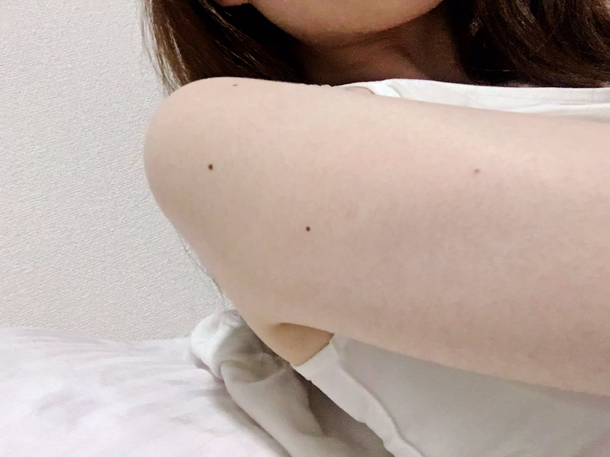 はうあ On Twitter 毛孔性苔癬レポ 二の腕の下側部分はまだブツブツが目立つかな ドクターブロナー社のマジックソープ を2016年10月 12月まで使ってブツブツが枯れた感じになり 1月辺りから市販の乾燥肌向けボディソープに変えたら一気に再発 またマジックソープに