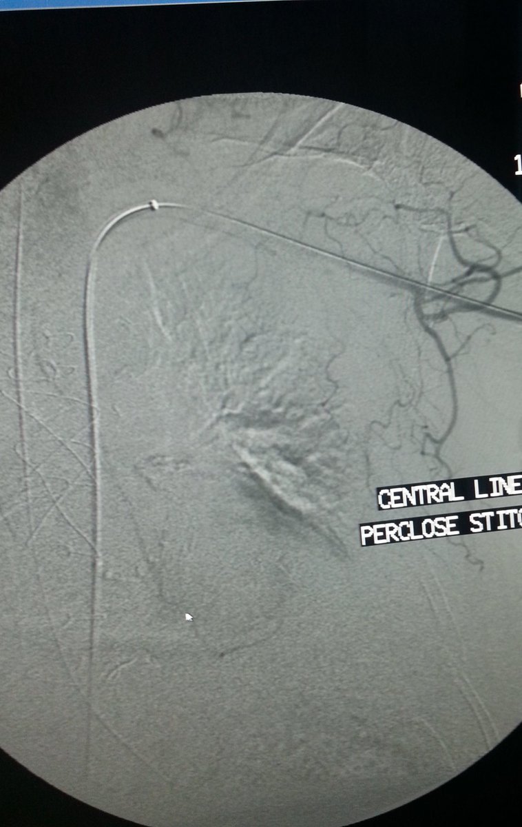 omarsaleh66's tweet image. Central line placed in the right subclavian artery , successfully removed and closed with #perclose , #Viabahn on hand just in case