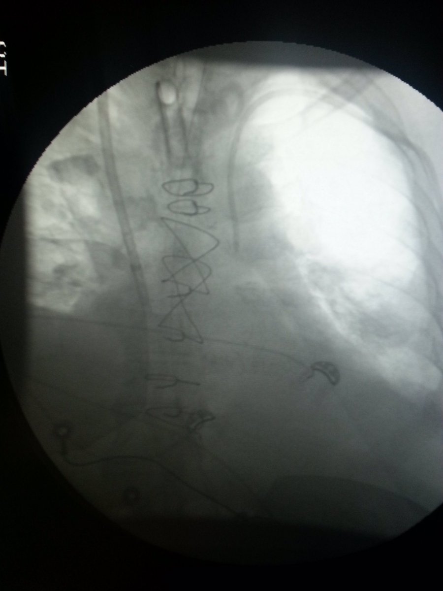 omarsaleh66's tweet image. Central line placed in the right subclavian artery , successfully removed and closed with #perclose , #Viabahn on hand just in case